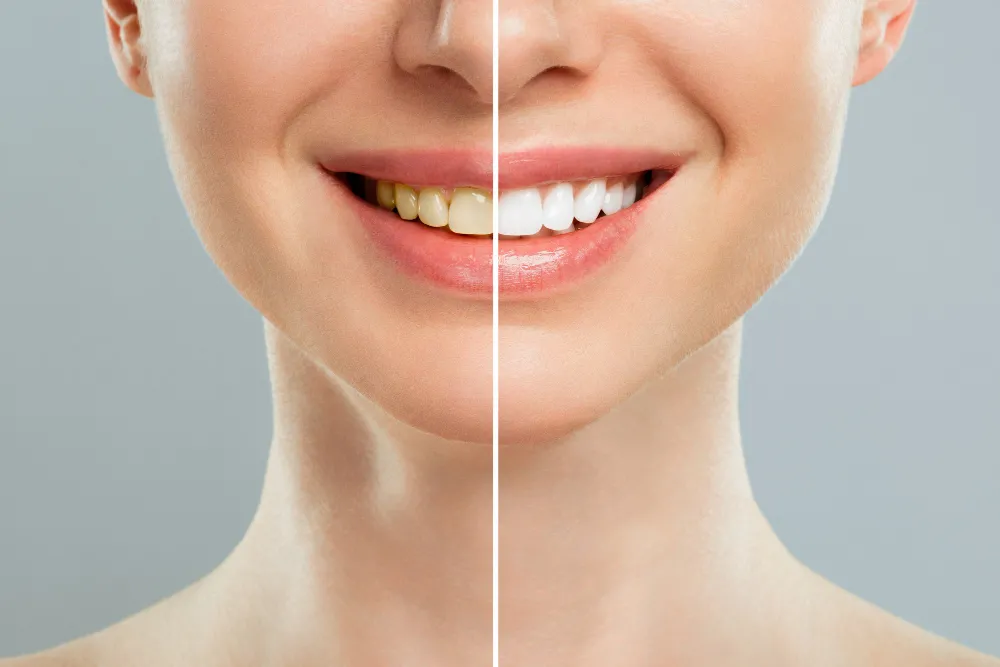 Teeth Yellow When I Brush Them Every Day