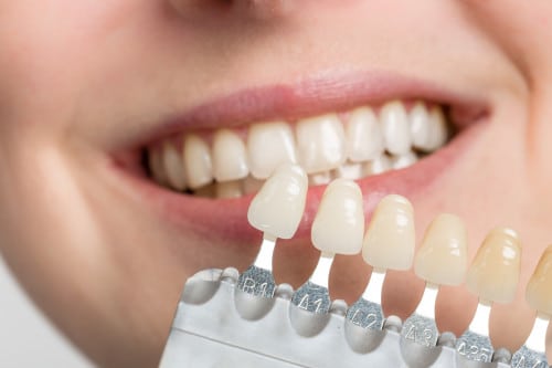 Smiling teeth veneer samples