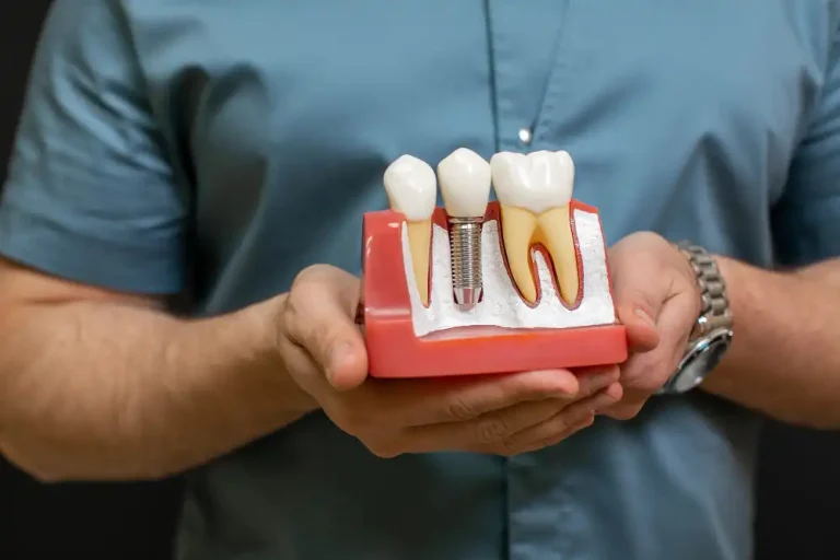 dental implant