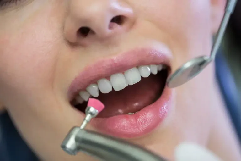 Teeth Bonding