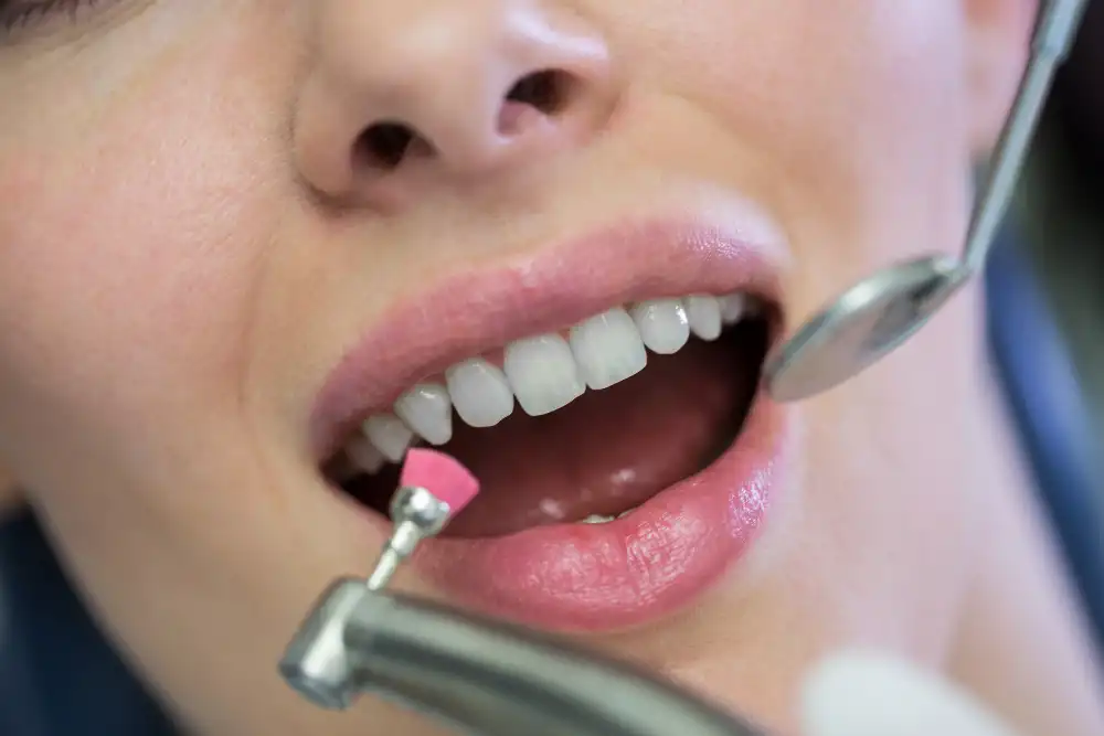 Teeth Bonding