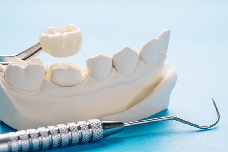 Replacing a Dental Crown: How Much Does It Cost?