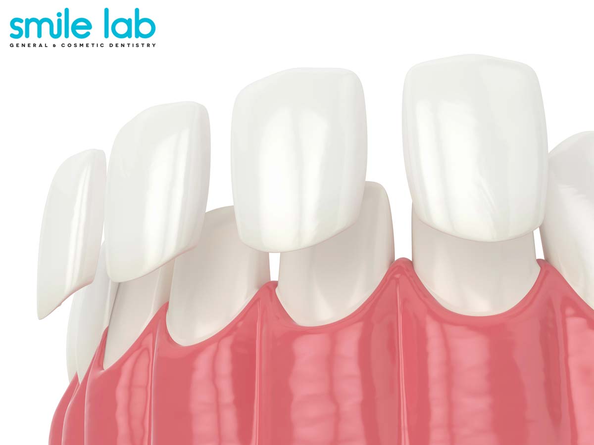 Are-Veneers-Permanent