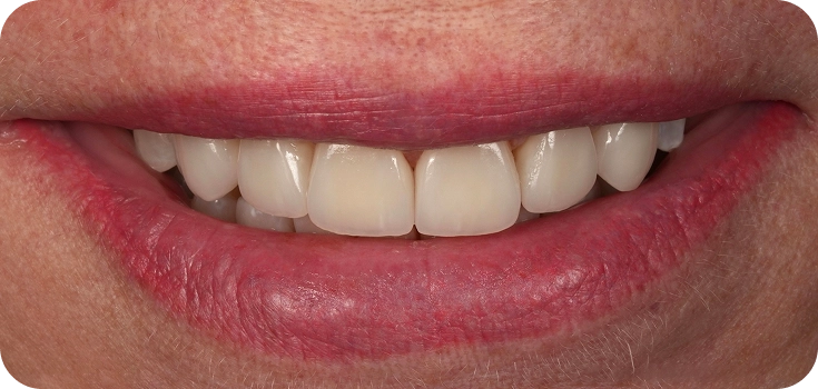 Close up of a smiling mouth after dental crown placement.