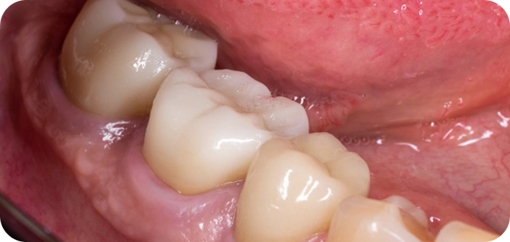 Close up of a mouth with dental crowns placed on the teeth by Smile Lab in NYC