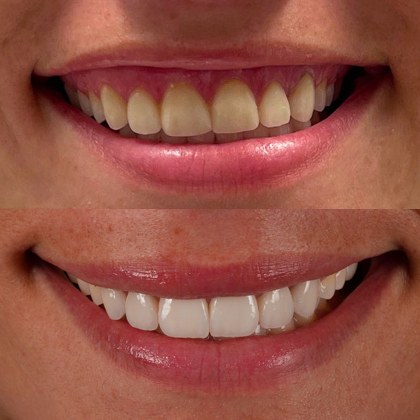 Before and after cosmetic teeth whitening and smile makeover