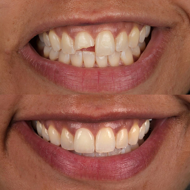 Before and after cosmetic dentistry to fix a chipped front tooth
