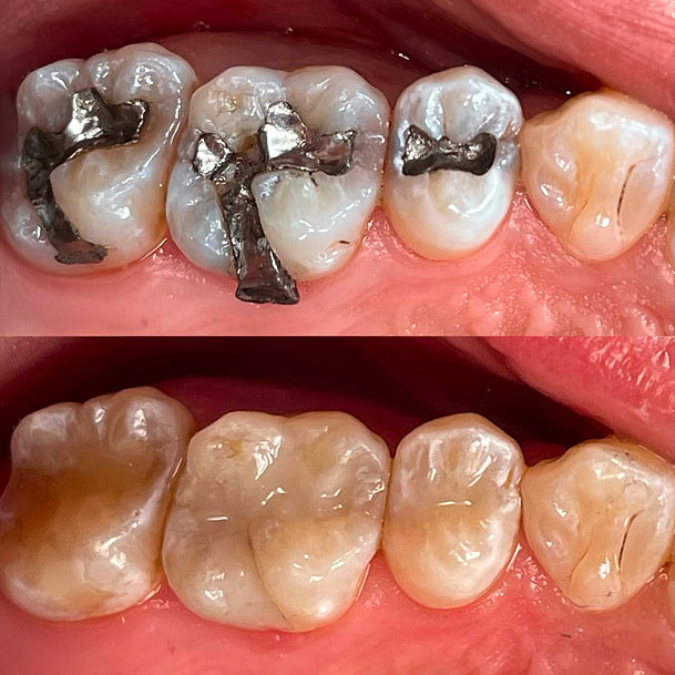 Before and after replacing silver amalgam fillings with white composite