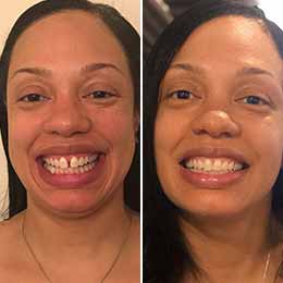 clear aligner before after crowding 7