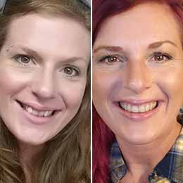 clear aligner before after manahttan 4