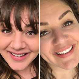 clear aligner before after manahttan 5