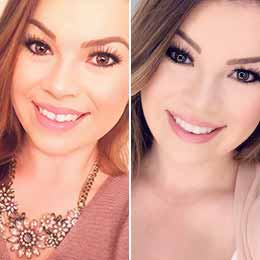 clear aligner before after manahttan
