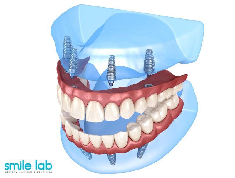 full-mouth-dental-implants-nyc