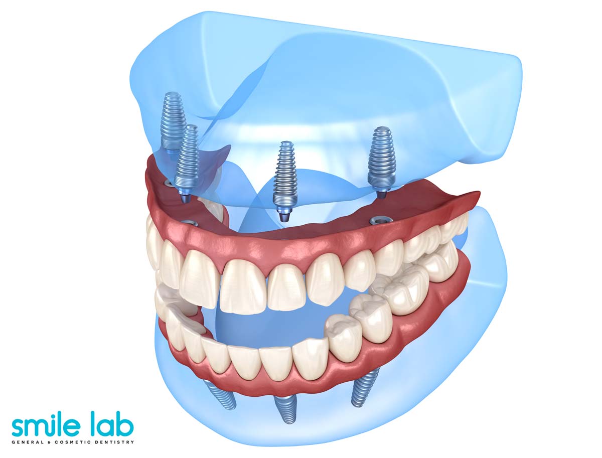full-mouth-dental-implants-nyc