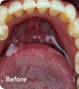 Minor Arch Crowding · 4-6 months Before
