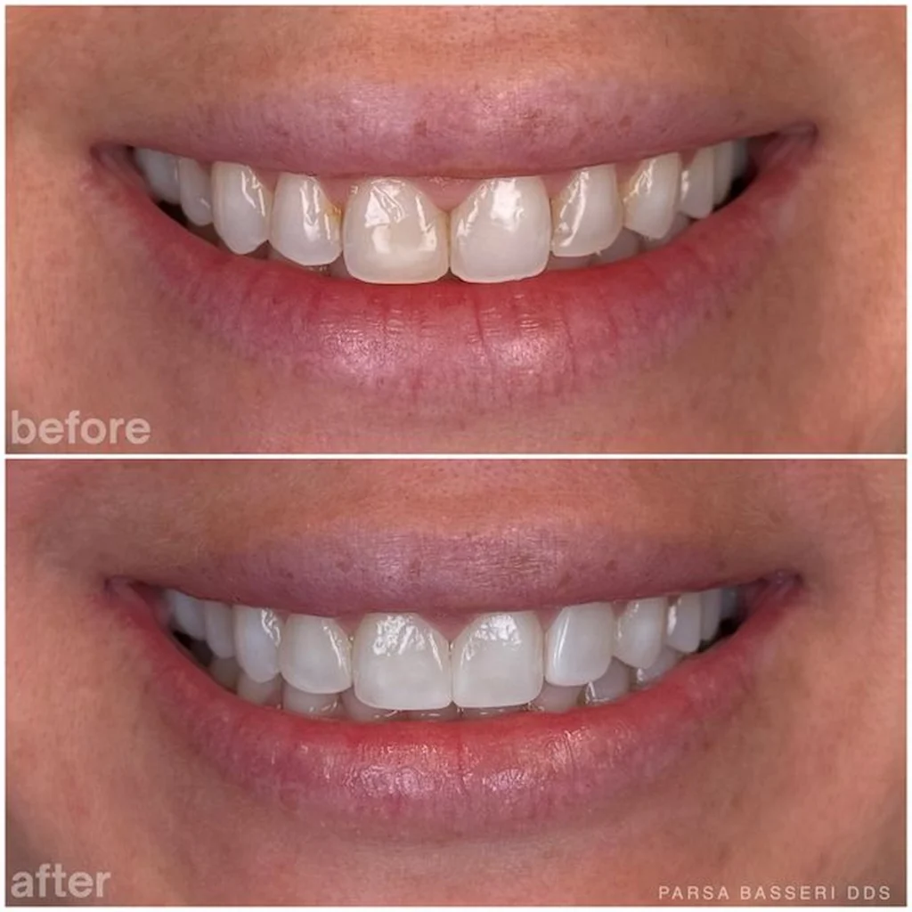teeth-cleaning-before-and-after
