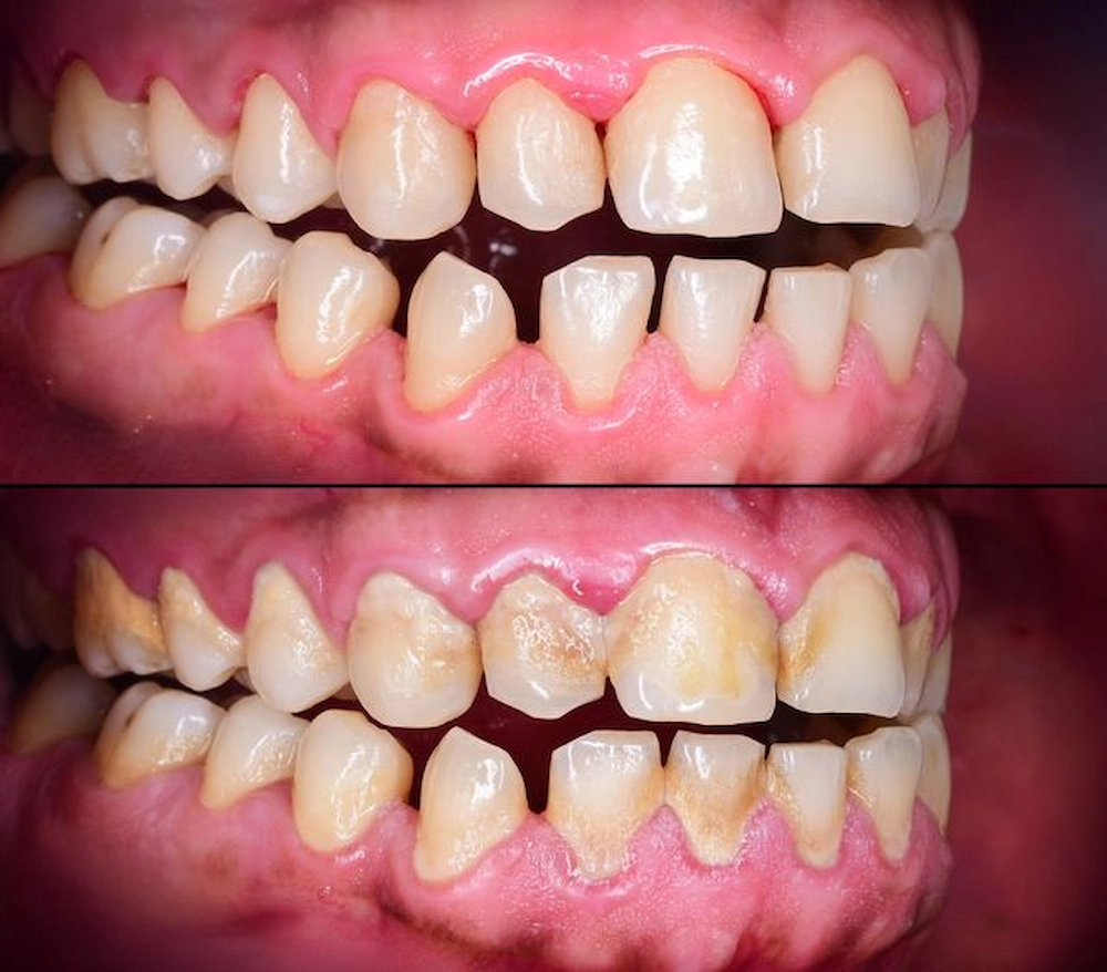 teeth-cleaning-before-and-after