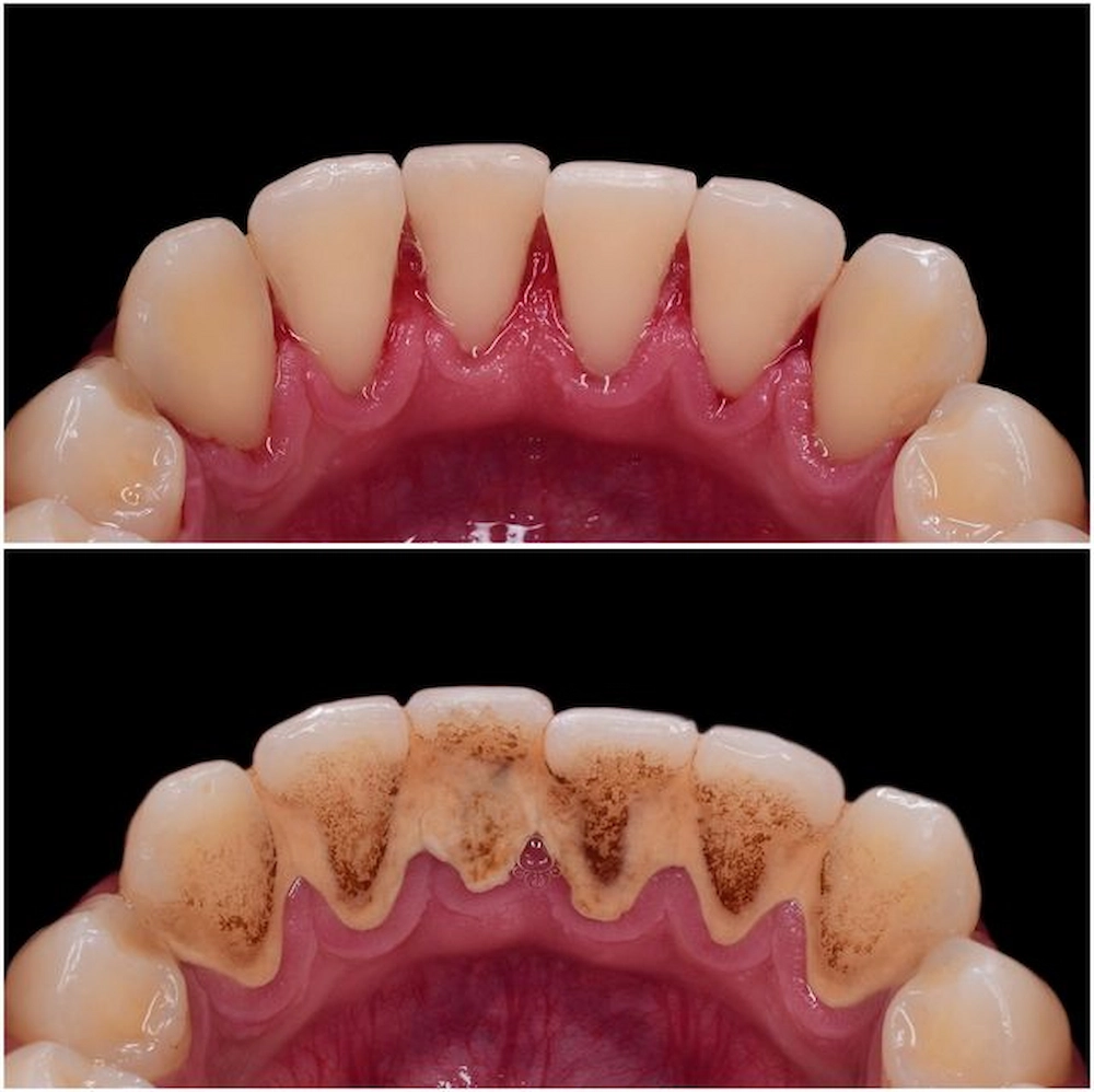 teeth-cleaning-before-and-after