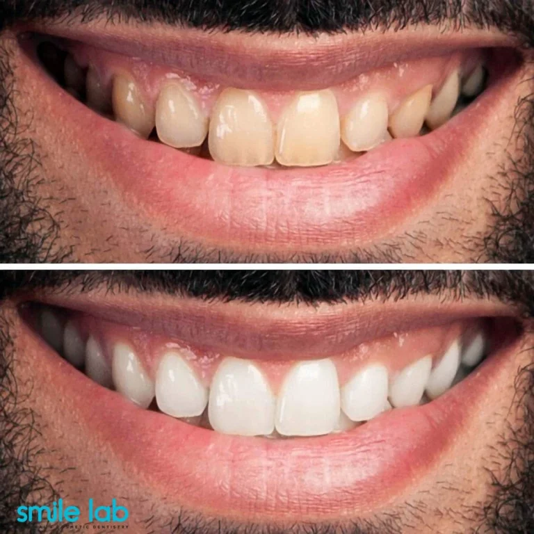 teeth-whitening-near-me-union-square