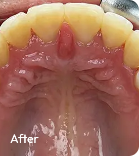 Upper Front Crowding · 5-7 months After