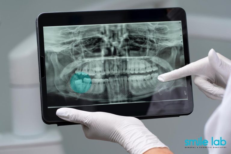 wisdom-tooth-removal-manhattan
